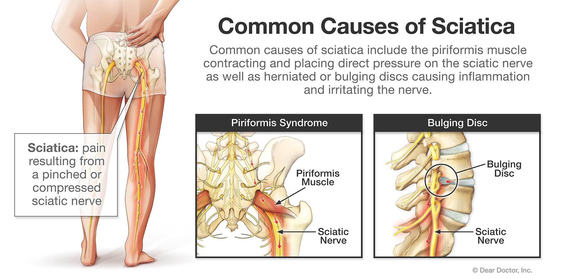 What Is The Difference Between Sciatica And Sciatic Nerve Pain? BOSIC